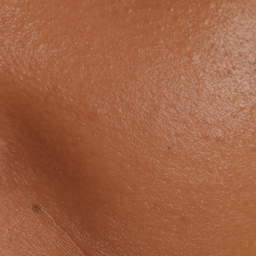 Enlarged Pores
