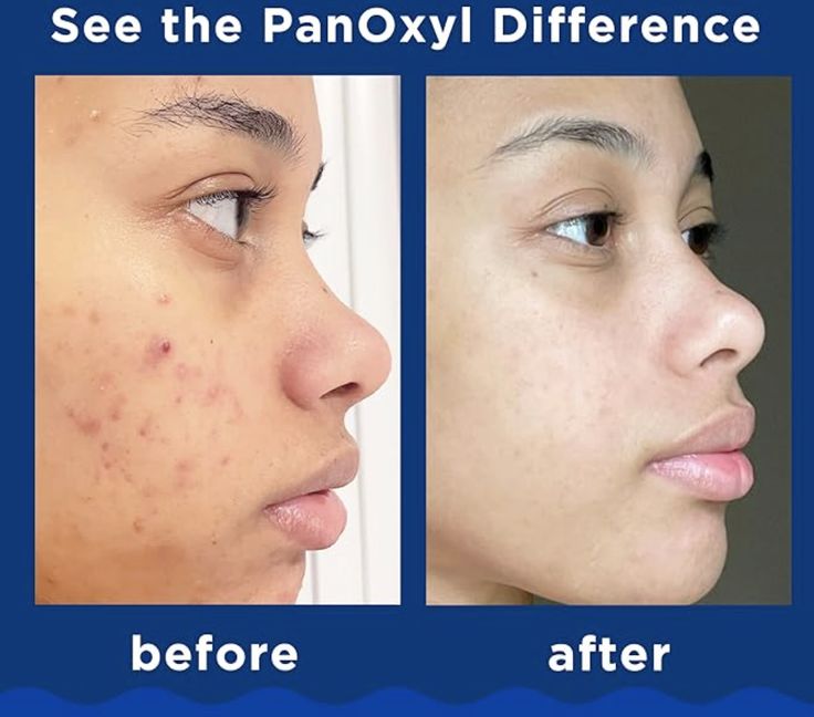 PanOxyl Acne Foaming Wash 10% Benzoyl Peroxide Maximum Strength 118ml